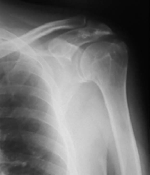図1.　肩関節のX線画像所見