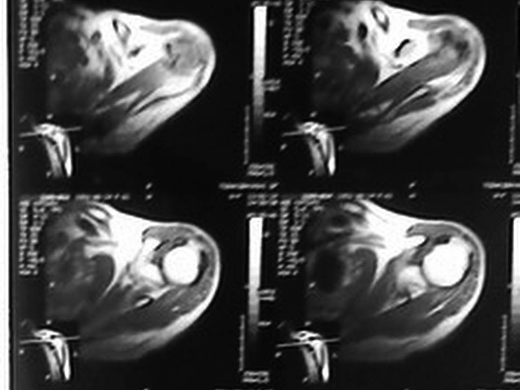 図2.　肩関節のMRI画像