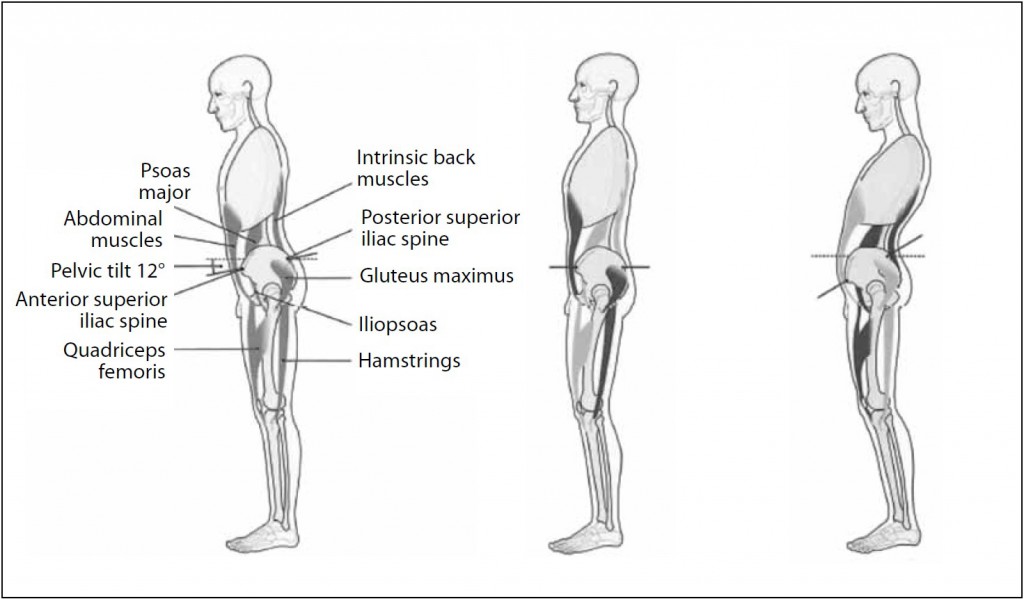 Fig. 2. Effect of rectus abdominis and iliopsoas hypertonus on pelvic angle and lumbar spinal curvature